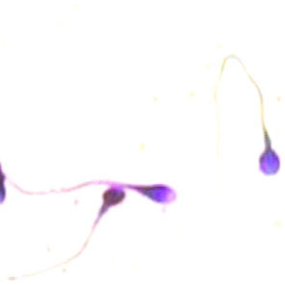 Leuco test pour les leucocytes du sperme